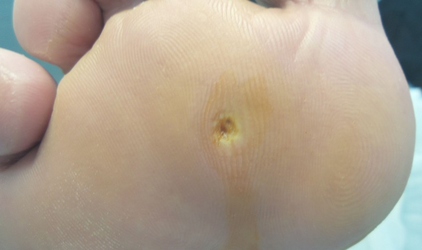 Бородавка на стопе - основные причины появления и методы избавления. Какой врач удаляет бородавки? (95 фото)