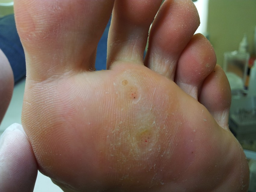 Бородавки на ногах: к какому врачу обращаться и советы по выбору лечения. Как убрать бородавку своими руками (105 фото)