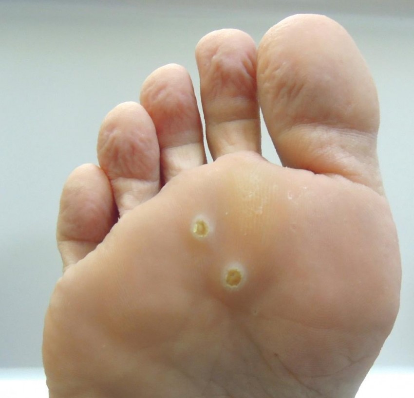 Бородавки на ногах: к какому врачу обращаться и советы по выбору лечения. Как убрать бородавку своими руками (105 фото)