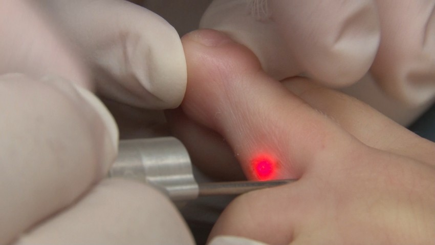 Бородавки на ногах: к какому врачу обращаться и советы по выбору лечения. Как убрать бородавку своими руками (105 фото)