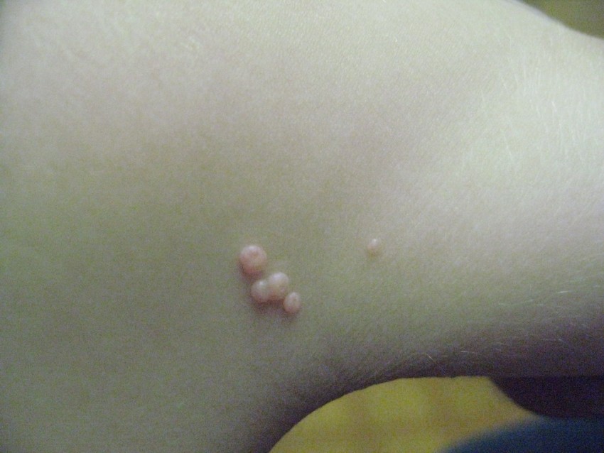 Бородавки на руках: причины появления, методы лечения и рекомендации по удалению (100 фото)