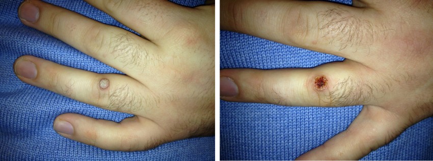 Бородавки на руках: причины появления, методы лечения и рекомендации по удалению (100 фото)