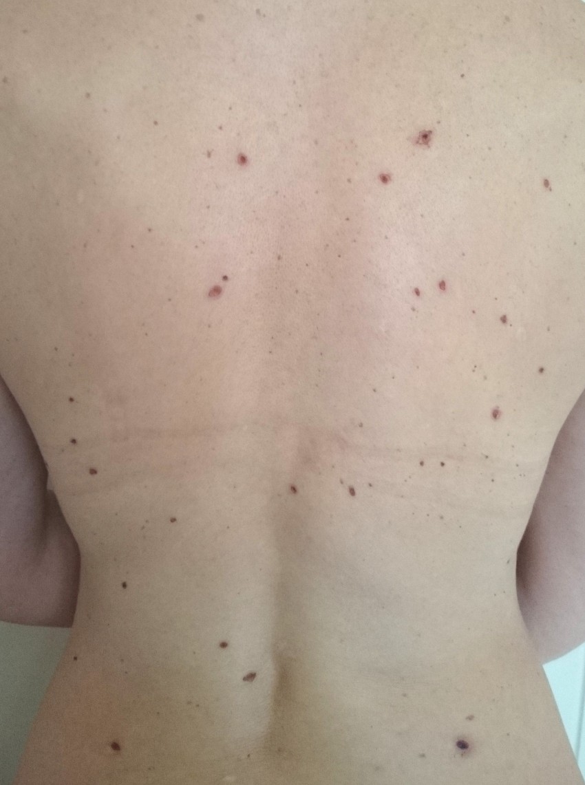 Бородавки на теле: описание видов, причины возникновения, лечение и профилактика. 115 фото бородавок