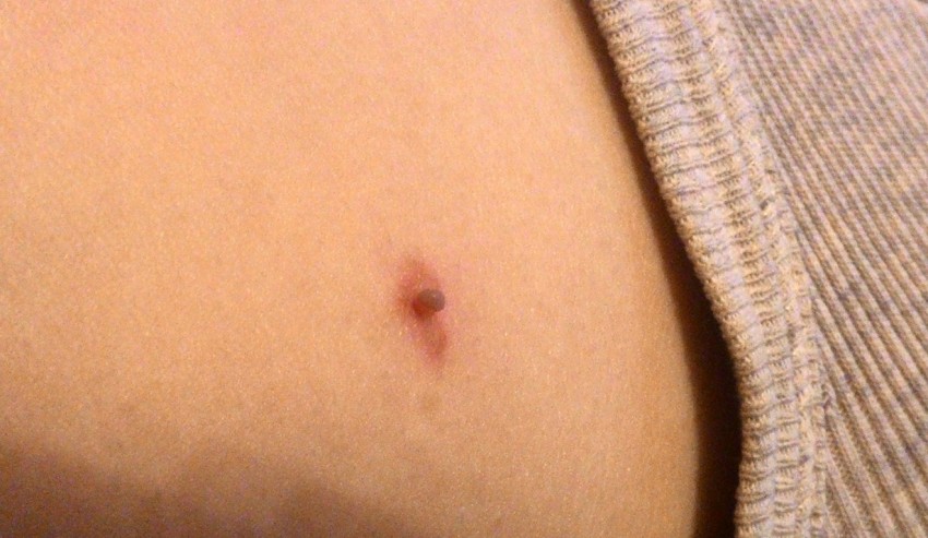 Бородавки на теле: описание видов, причины возникновения, лечение и профилактика. 115 фото бородавок