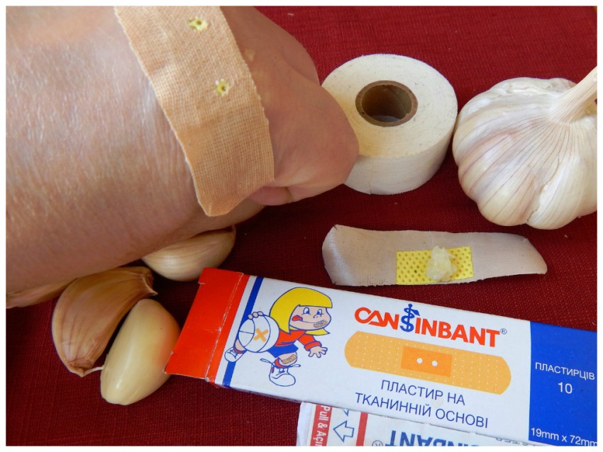 Бородавки на теле: описание видов, причины возникновения, лечение и профилактика. 115 фото бородавок