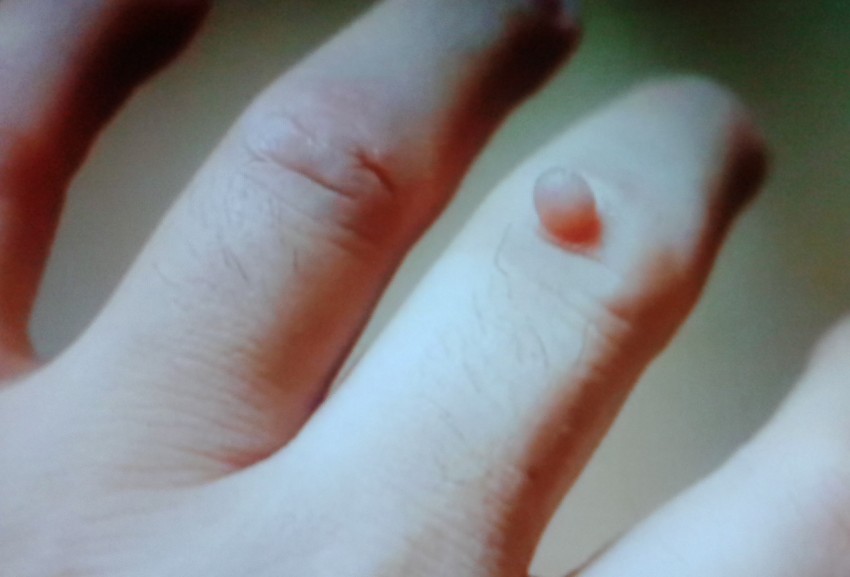 Бородавки у детей - причины появления, способы избавления и правила удаления. Медицинские и народные способы лечения бородавок (125 фото)