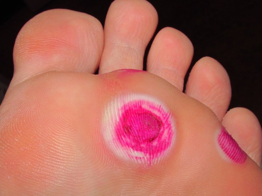 Бородавки у детей - причины появления, способы избавления и правила удаления. Медицинские и народные способы лечения бородавок (125 фото)