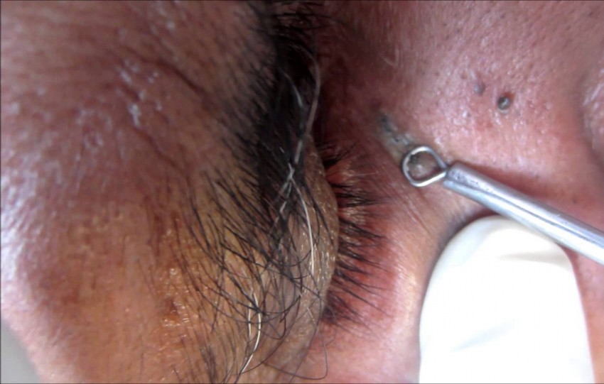 Черный прыщ: особенности, принципы лечения, советы дерматологов и причины появления (125 фото и видео)