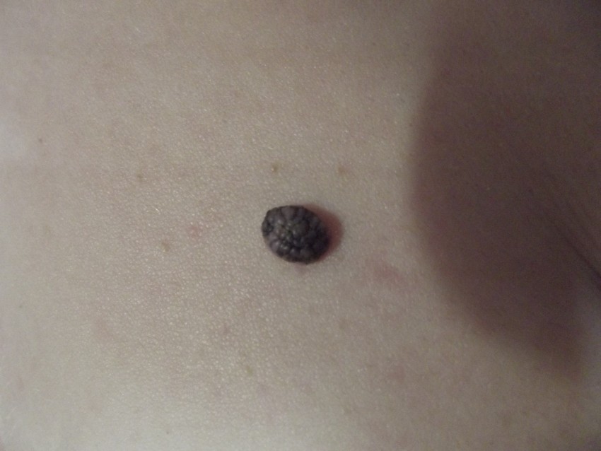 Чешется родинка - поиск причины, варианты лечения и советы по уходу за областью вокруг родинки (100 фото)