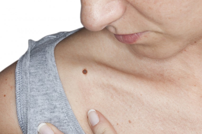 Чешется родинка - поиск причины, варианты лечения и советы по уходу за областью вокруг родинки (100 фото)