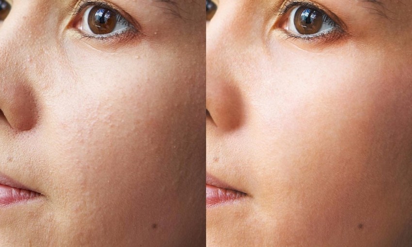 Чистка кожи лица: советы дерматолога, виды, отзывы о методах и обзор цен. 135 фото самых эффективных средств и способов очистки кожи лица