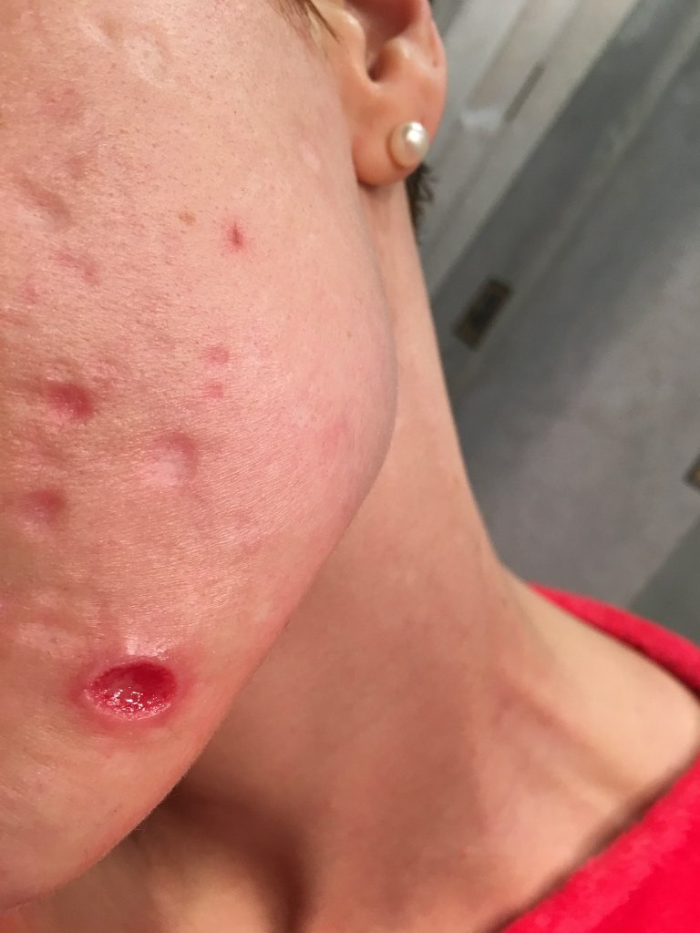 Демодекоз - симптомы, причины, диагностика и современное лечение заболевания (95 фото + видео)