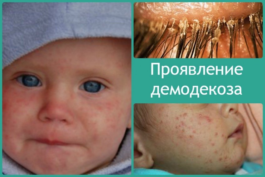 Демодекоз - симптомы, причины, диагностика и современное лечение заболевания (95 фото + видео)
