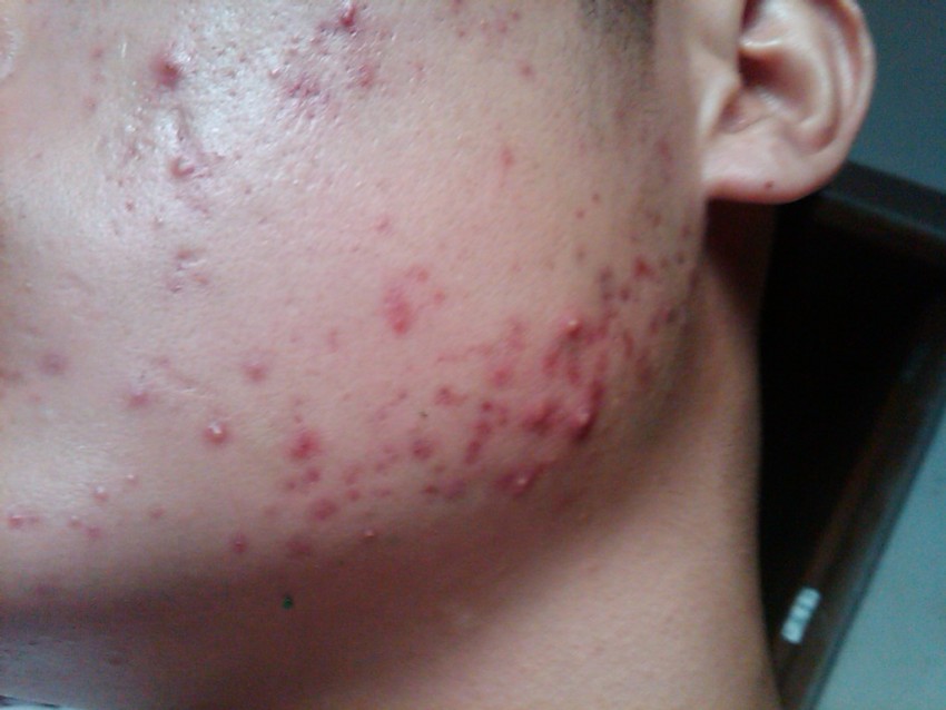 Демодекоз - симптомы, причины, диагностика и современное лечение заболевания (95 фото + видео)