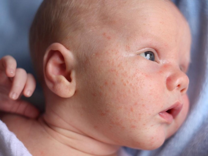 Дерматит на лице: причины появления, стадии, диагностика и основные методы лечения у детей и взрослых. 115 фото и видео советы врачей