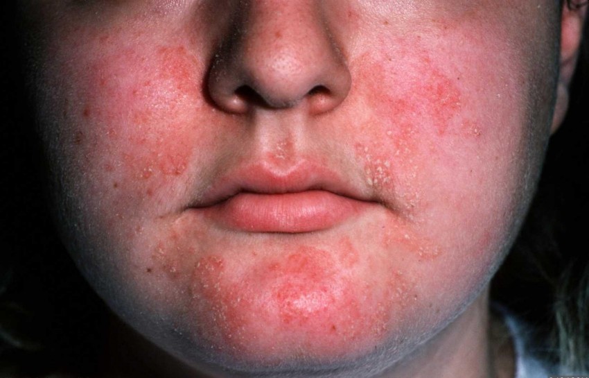 Дерматит на лице: причины появления, стадии, диагностика и основные методы лечения у детей и взрослых. 115 фото и видео советы врачей