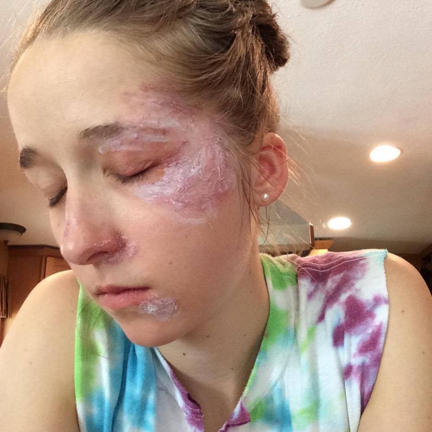 Дерматит на лице: причины появления, стадии, диагностика и основные методы лечения у детей и взрослых. 115 фото и видео советы врачей