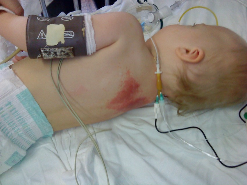 Дерматит у детей - основные причины, симптомы, диагностика и варианты лечения. Видео + 120 фото проявлений детского дерматита