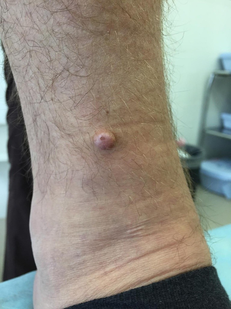 Дерматофиброма - что это такое, почему появляется и как лечится современными методами. Советы и рекомендации врачей по удалению образования (100 фото + видео)