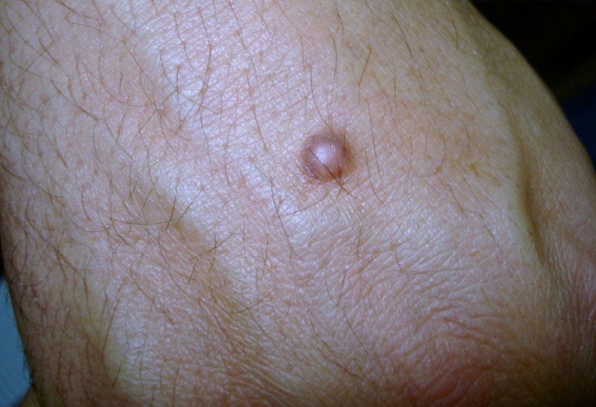 Дерматофиброма - что это такое, почему появляется и как лечится современными методами. Советы и рекомендации врачей по удалению образования (100 фото + видео)