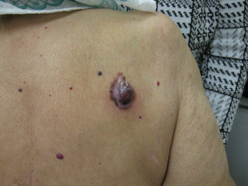 Дерматофиброма - что это такое, почему появляется и как лечится современными методами. Советы и рекомендации врачей по удалению образования (100 фото + видео)