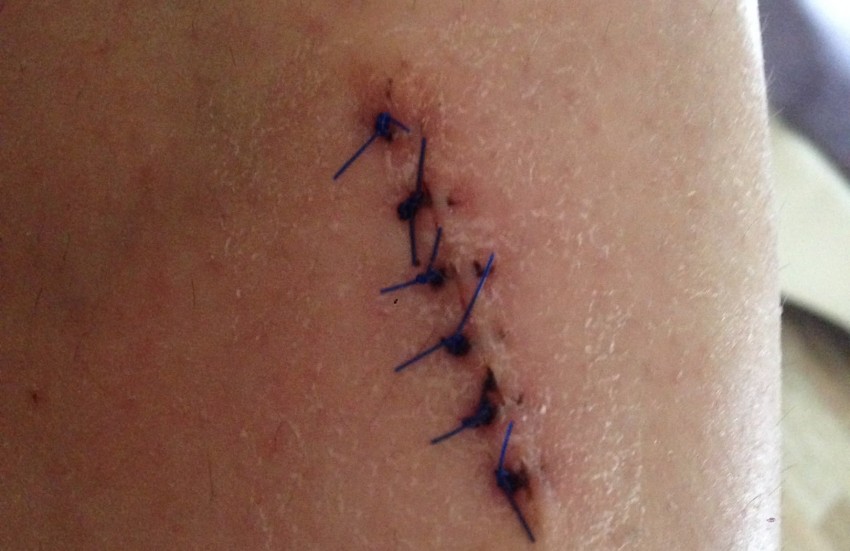 Дерматофиброма - что это такое, почему появляется и как лечится современными методами. Советы и рекомендации врачей по удалению образования (100 фото + видео)