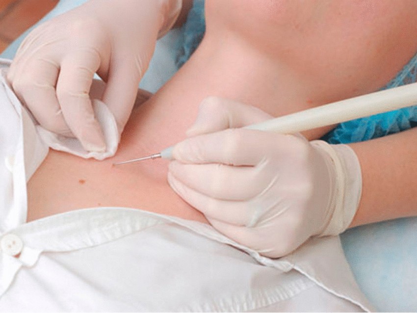 Дерматофиброма - что это такое, почему появляется и как лечится современными методами. Советы и рекомендации врачей по удалению образования (100 фото + видео)