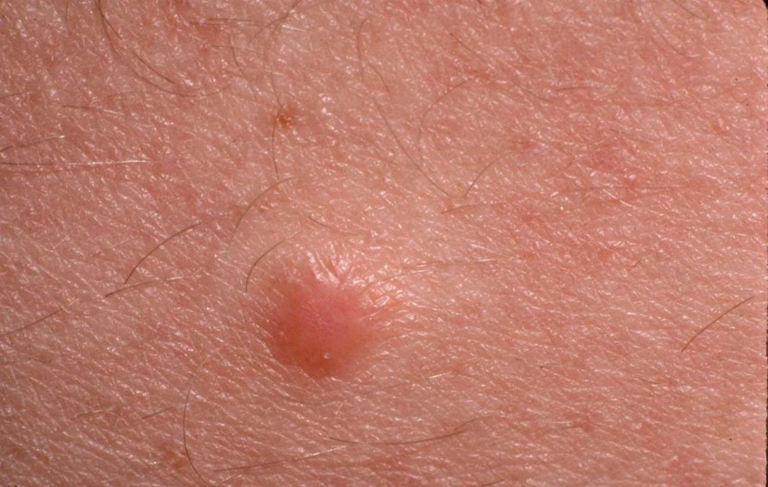 Дерматофиброма - что это такое, почему появляется и как лечится современными методами. Советы и рекомендации врачей по удалению образования (100 фото + видео)