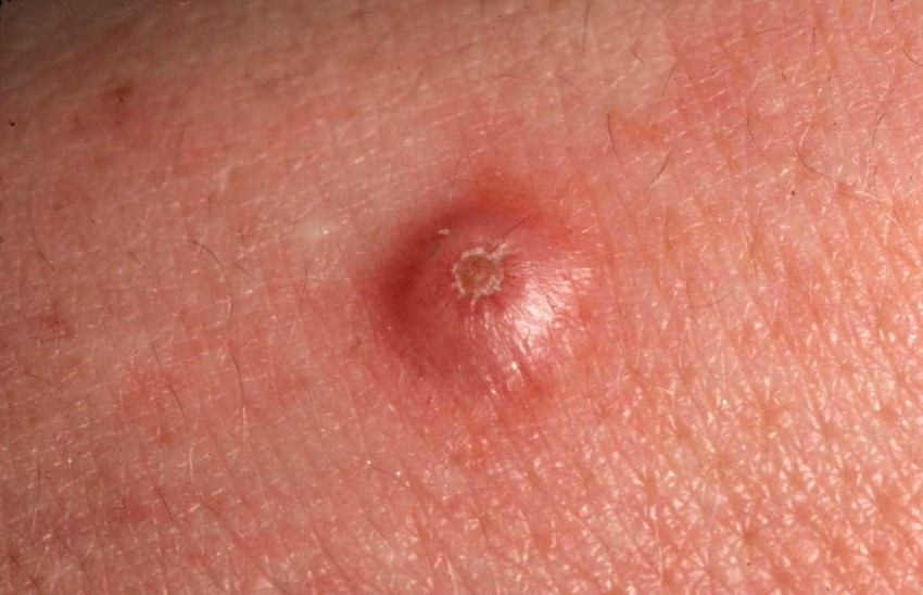 Дерматофиброма - что это такое, почему появляется и как лечится современными методами. Советы и рекомендации врачей по удалению образования (100 фото + видео)