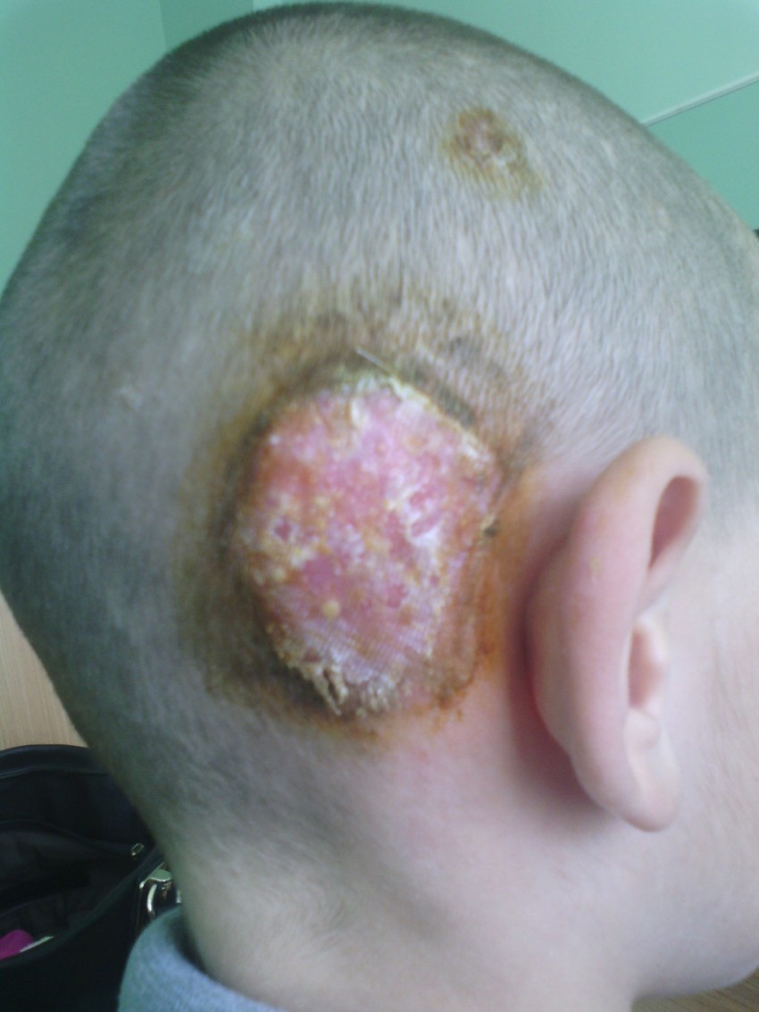 Дерматомикоз: основные виды, первые симптомы и проявления, лечение и профилактика заболевания (видео + 90 фото)