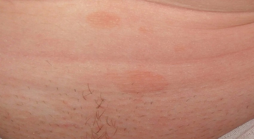 Дерматомикоз: основные виды, первые симптомы и проявления, лечение и профилактика заболевания (видео + 90 фото)