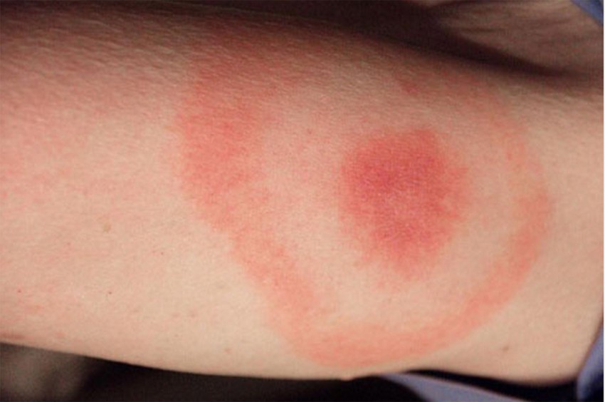 Дерматомикоз: основные виды, первые симптомы и проявления, лечение и профилактика заболевания (видео + 90 фото)