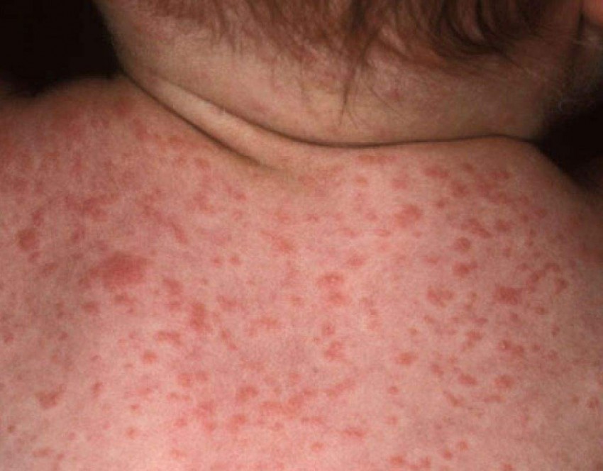 Дерматомикоз: основные виды, первые симптомы и проявления, лечение и профилактика заболевания (видео + 90 фото)