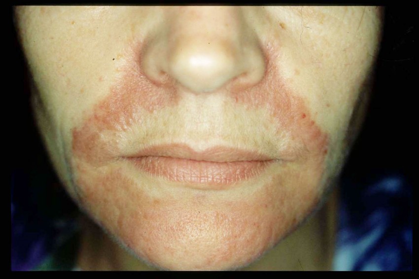 Дерматомикоз: основные виды, первые симптомы и проявления, лечение и профилактика заболевания (видео + 90 фото)