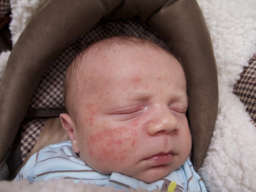 Диатез у ребенка - симптомы, этапы протекания и лечение аллергического дерматита у детей (130 фото)