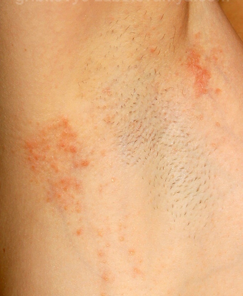 Фото лишая - основные виды, описание заболевания, признаки и современные методы лечения