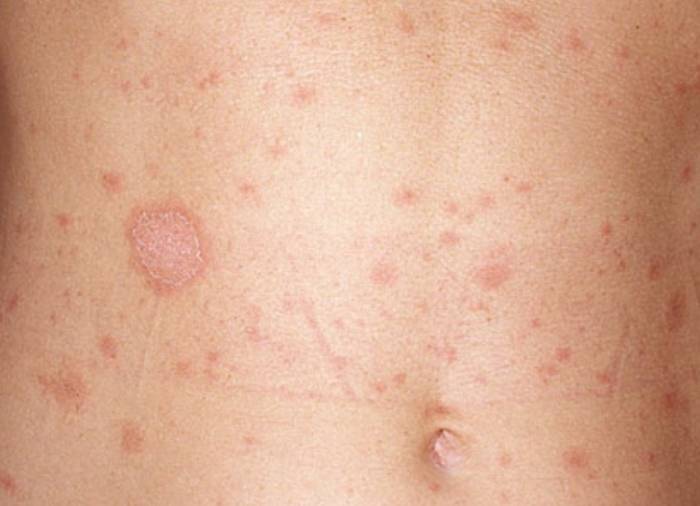 Фото лишая - основные виды, описание заболевания, признаки и современные методы лечения