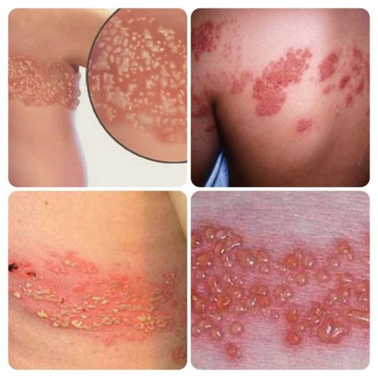 Фото лишая - основные виды, описание заболевания, признаки и современные методы лечения