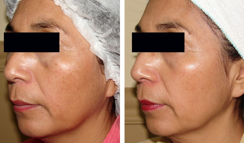 Фотоомоложение лица - описание и отзывы дерматологов и косметологов о процедуре. 125 фото и видео проведения процедуры