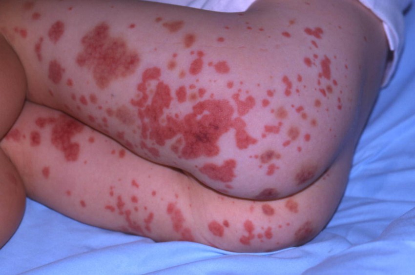 Геморрагический васкулит: причины возникновения, диагностика, лечение, формы и симптомы (110 фото)
