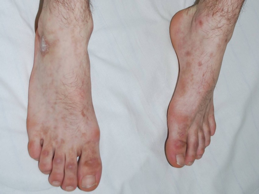 Геморрагический васкулит: причины возникновения, диагностика, лечение, формы и симптомы (110 фото)