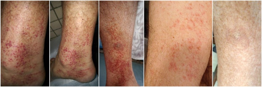 Геморрагический васкулит: причины возникновения, диагностика, лечение, формы и симптомы (110 фото)