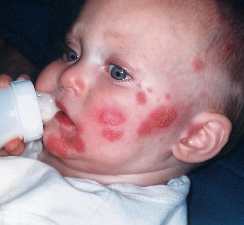 Герпес у детей - причины появления, симптомы, диагностика, методы избавления и варианты лечения (100 фото)