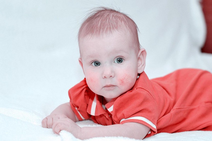 Гиперемия: причины, лечение, симптомы. К какому врачу обращаться и как устранить заболевание кожи в домашних условиях (80 фото)