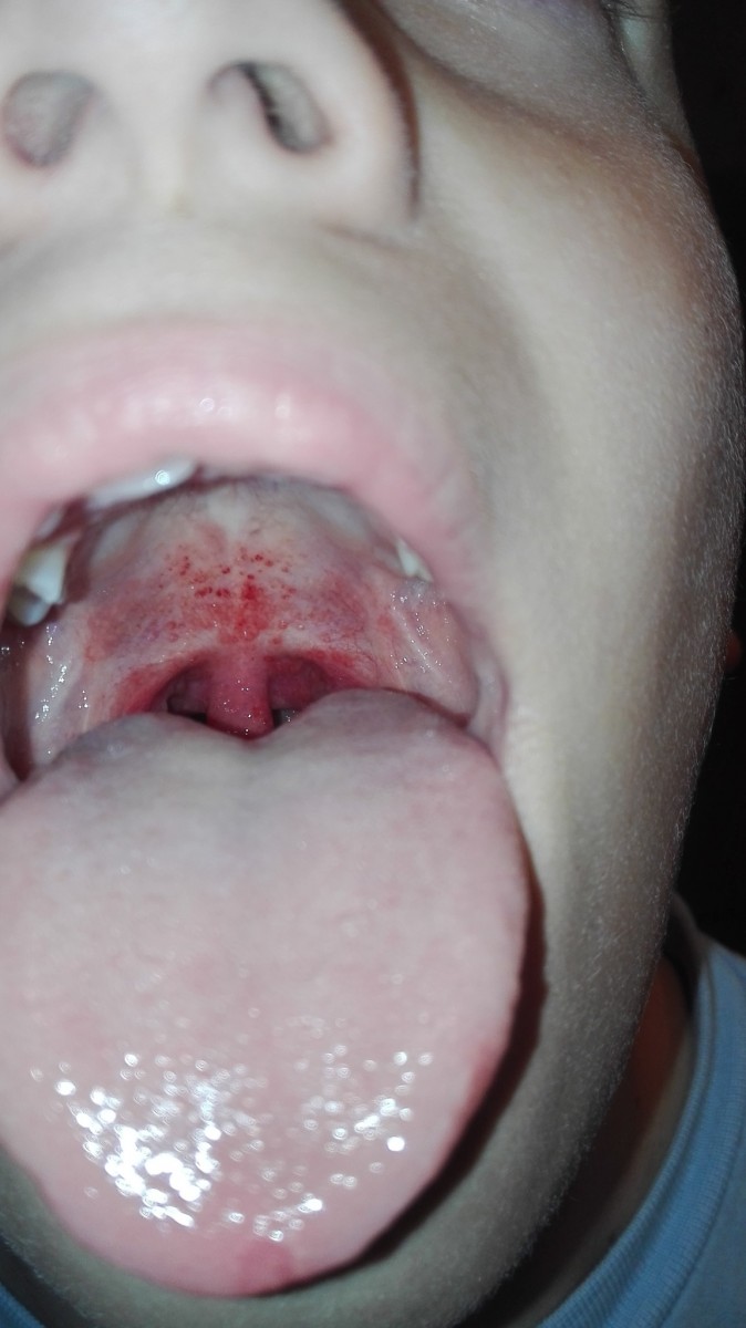 Гиперемия: причины, лечение, симптомы. К какому врачу обращаться и как устранить заболевание кожи в домашних условиях (80 фото)