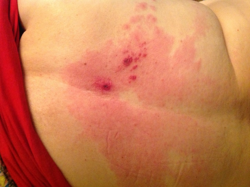 Гиперемия: причины, лечение, симптомы. К какому врачу обращаться и как устранить заболевание кожи в домашних условиях (80 фото)