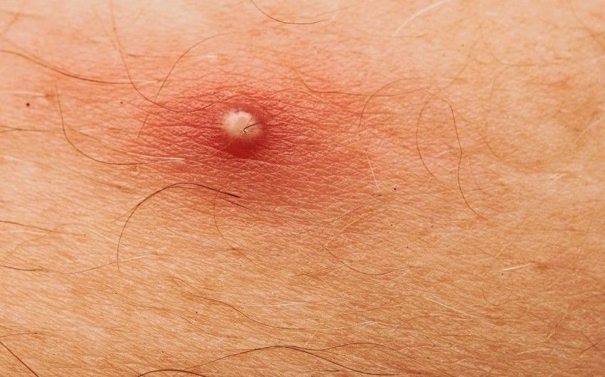 Гнойные прыщи - как быстро и эффективно избавиться в домашних условиях. Советы и рекомендации дерматологов по лечению (115 фото)