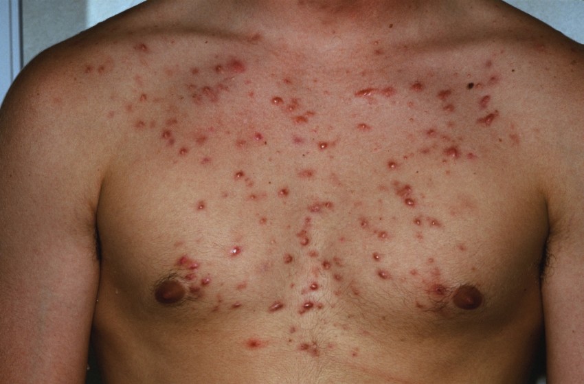 Гнойные прыщи - как быстро и эффективно избавиться в домашних условиях. Советы и рекомендации дерматологов по лечению (115 фото)