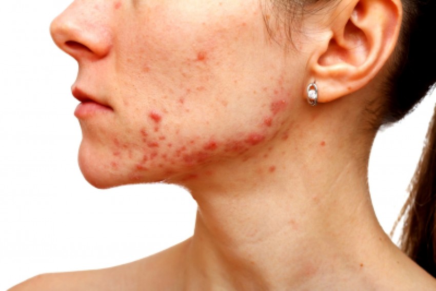Гормональные прыщи: признаки и проявления, методы борьбы и ошибки при диагностике причины прыщей (105 фото + видео)