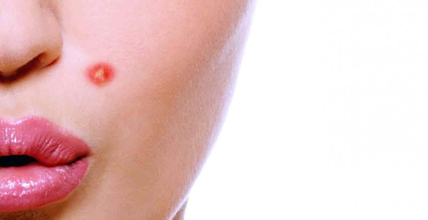 Гормональные прыщи: признаки и проявления, методы борьбы и ошибки при диагностике причины прыщей (105 фото + видео)